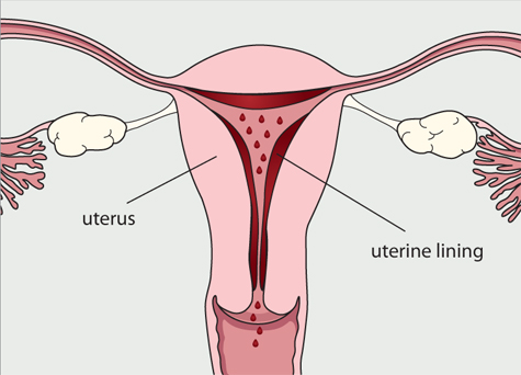 Diagram of the female reproductive system. The blood and tissue lining the uterus (womb) are breaking down  and sheding from the body.