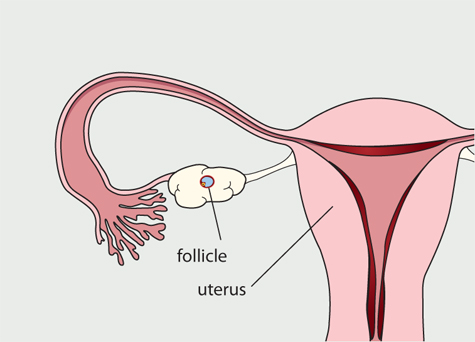 Diagram of the female reproductive system. Fluid filled pockets have formed on the ovary
