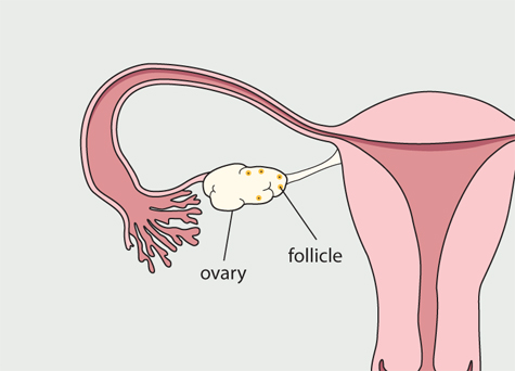 Diagram of the female reproductive system. Fluid filled pockets have formed on the ovary.