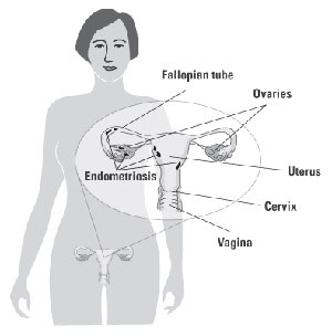 Diagrama de la endometriosis